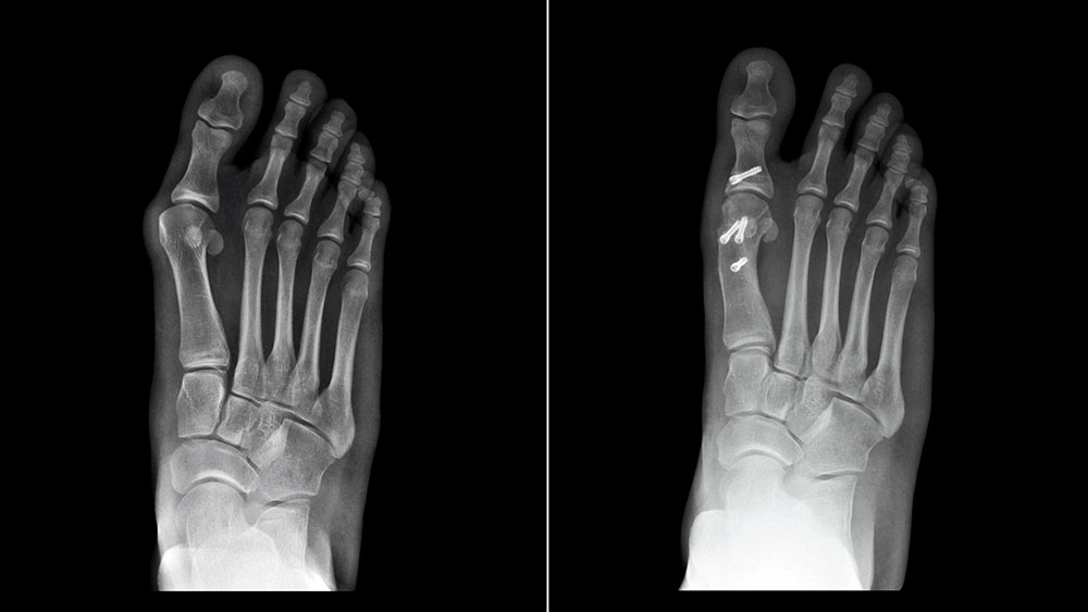 Home bunion x ray