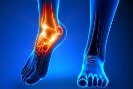 Home calcaneus fractures