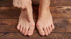 Home hallux valgus