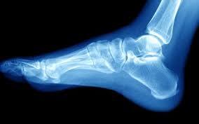 Home malleolar fractures
