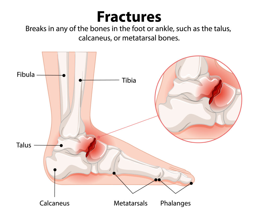 foot and ankle fracture diagram