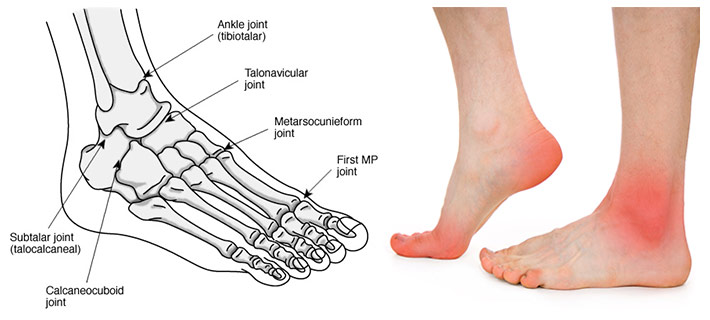 arthritis in the foot and ankle