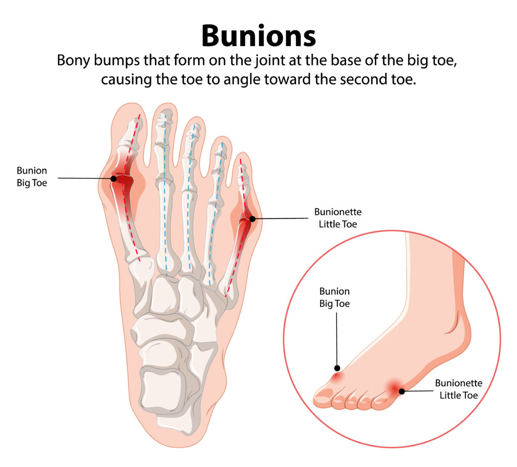 bunions and bunionette illustration