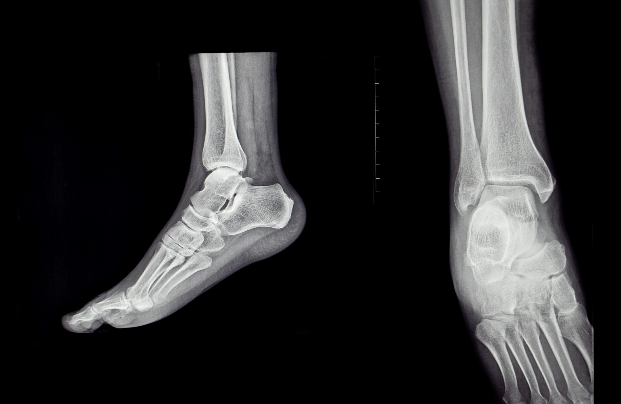 a close up x ray of the sole of the human foot