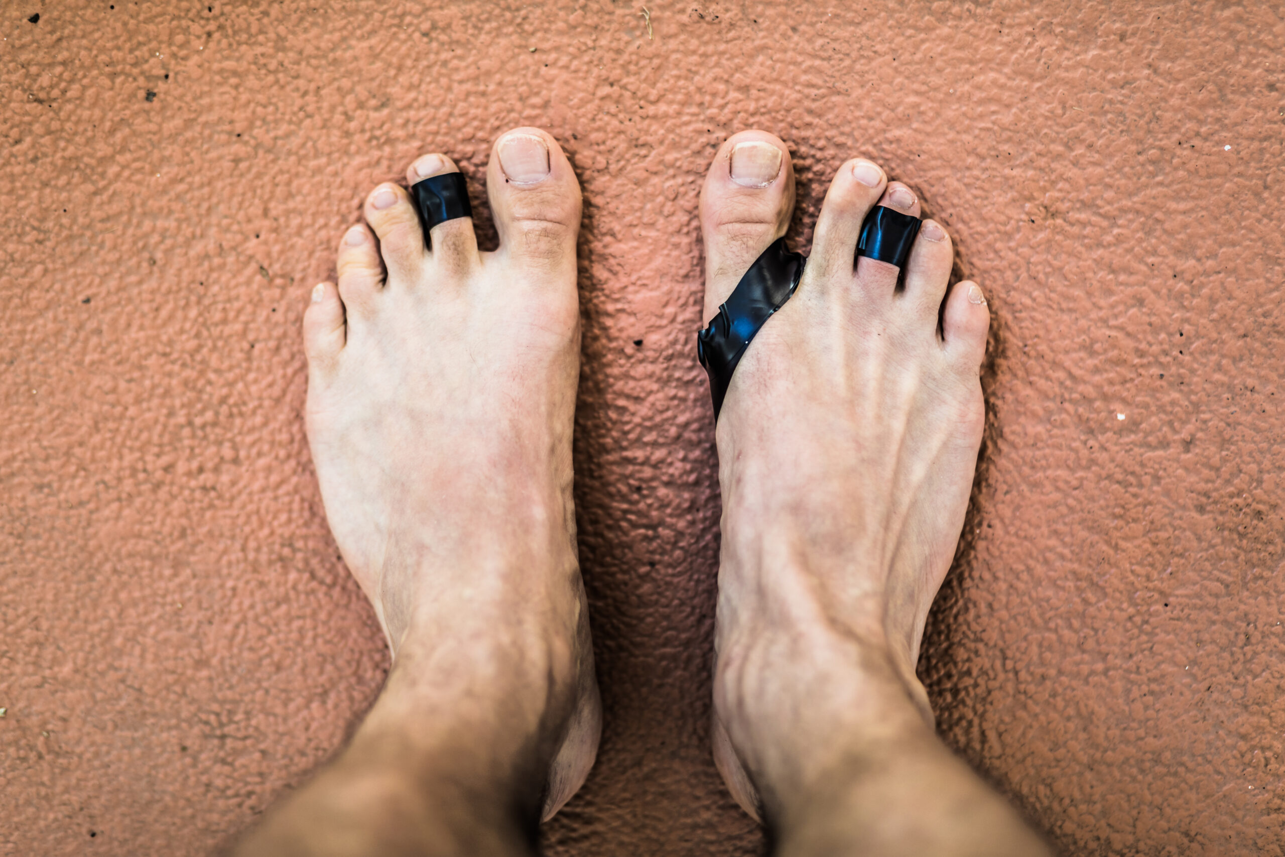 Hammertoe Treatment